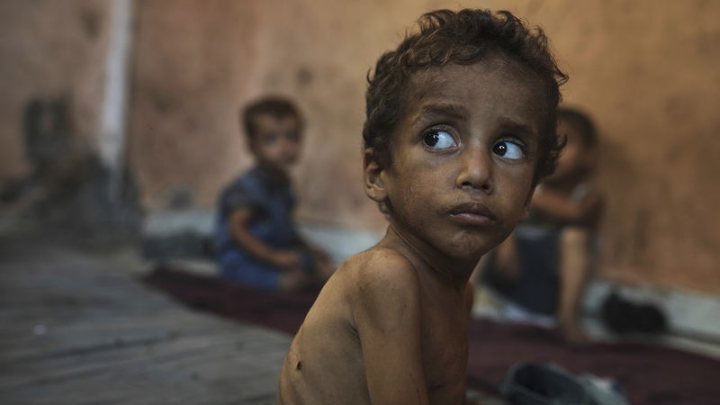 Undernärda tvååringen Yazan Abu Ful sitter i sitt familjehem i flyktinglägret Shati, Gaza stad, den 23 juli 2025. Foto: Jehad Alshrafi./AP/TT.